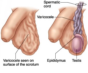 varicocele.jpg